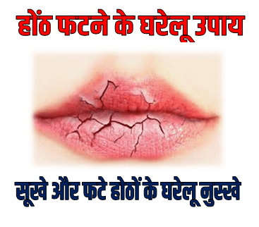 होंठ फटने का घरेलू उपाय In Hindi
