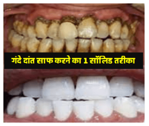 गंदे दांत साफ करने का 1 सॉलिड तरीका जाने
